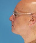 after neck lift male patient left side view case 2685