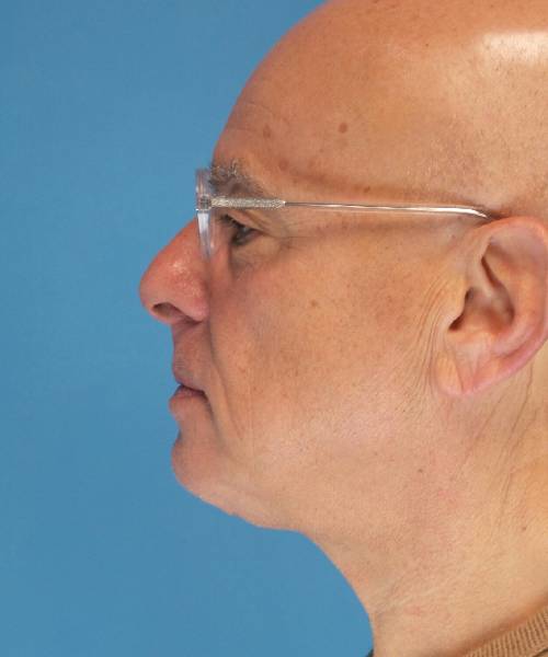 after neck lift male patient left side view case 2685