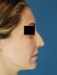 before rhinoplasty female patient right side view case 1898