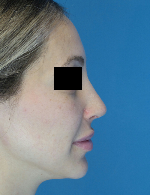 after rhinoplasty female patient right side view case 1898