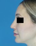 after rhinoplasty female patient left side view case 1898