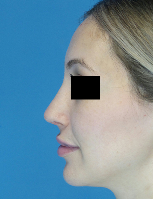 after rhinoplasty female patient left side view case 1898