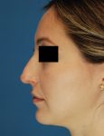 before rhinoplasty female patient left side view case 1898