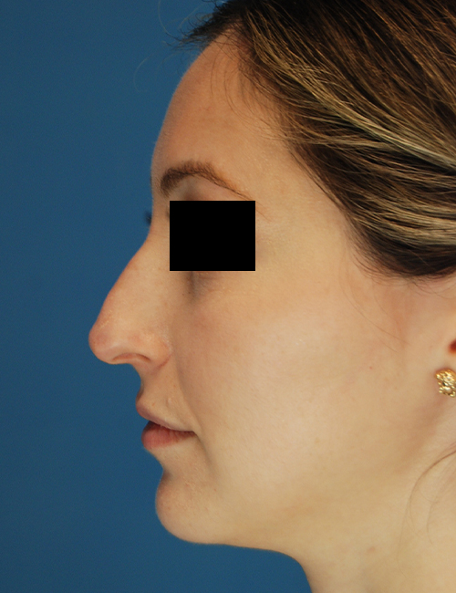 before rhinoplasty female patient left side view case 1898