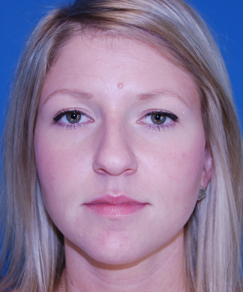 before rhinoplasty female patient front view case 2280