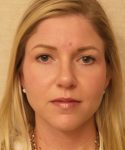after rhinoplasty female patient front view case 2280