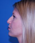 before rhinoplasty female patient left side view case 2280