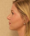 after rhinoplasty female patient left side view case 2280