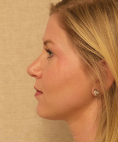 after rhinoplasty female patient left side view case 2280