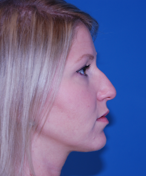 before rhinoplasty female patient right side view case 2280