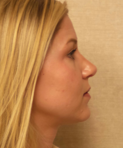 after rhinoplasty female patient right side view case 2280