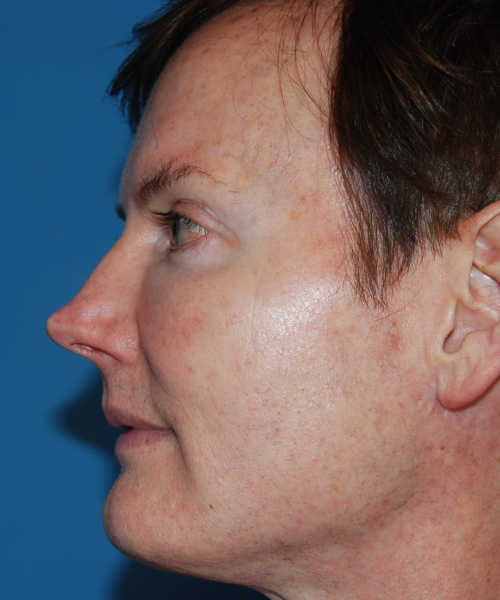 before rhinoplasty male patient left side view case 2287
