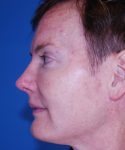 after rhinoplasty male patient left side view case 2287