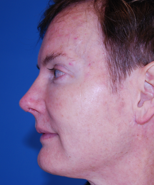 after rhinoplasty male patient left side view case 2287