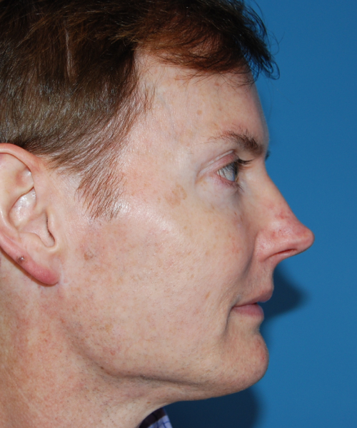 before rhinoplasty male patient right side view case 2287