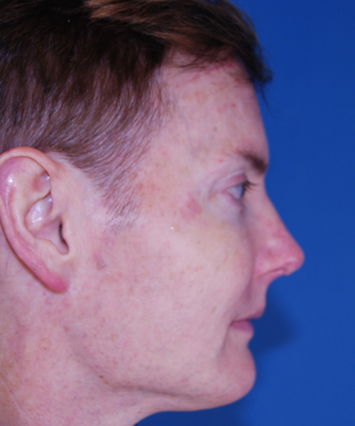 after rhinoplasty male patient right side view case 2287
