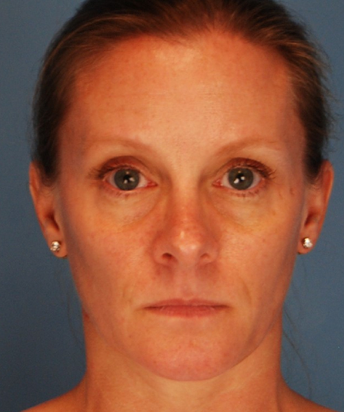 before rhinoplasty female patient front view case 2292
