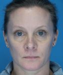after rhinoplasty female patient front view case 2292