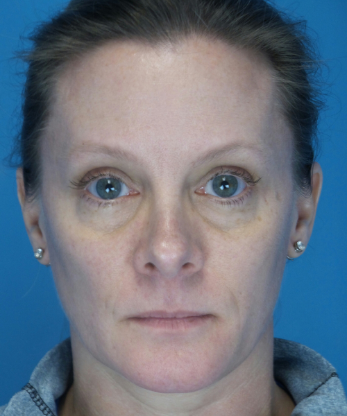 after rhinoplasty female patient front view case 2292