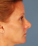 before rhinoplasty female patient right side view case 2292