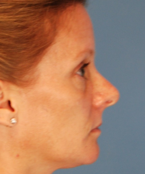 before rhinoplasty female patient right side view case 2292