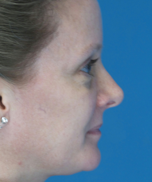 after rhinoplasty female patient right side view case 2292