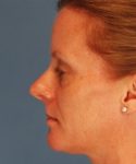 before rhinoplasty female patient left side view case 2292