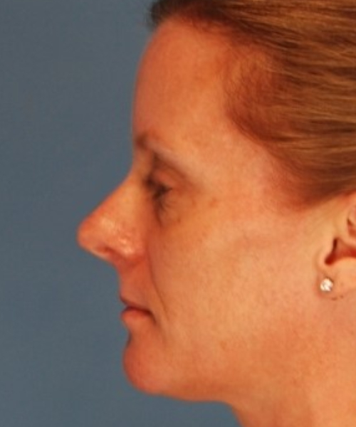 before rhinoplasty female patient left side view case 2292