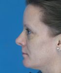 after rhinoplasty female patient left side view case 2292