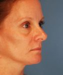 before rhinoplasty female patient right angle view case 2292