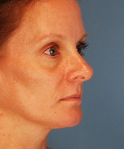 before rhinoplasty female patient right angle view case 2292