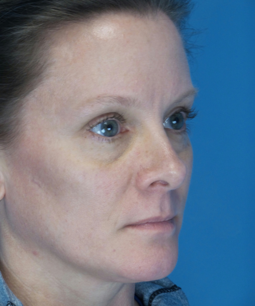after rhinoplasty female patient right angle view case 2292
