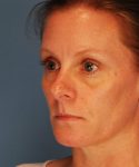 before rhinoplasty female patient left angle view case 2292