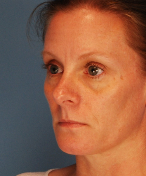before rhinoplasty female patient left angle view case 2292