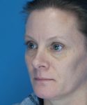 after rhinoplasty female patient left angle view case 2292