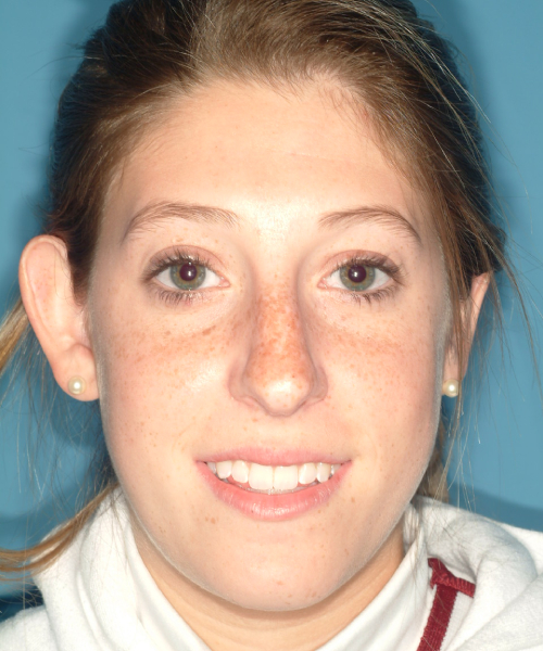 before rhinoplasty female patient front view case 2303