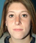 after rhinoplasty female patient front view case 2303