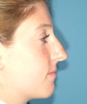 before rhinoplasty female patient right side view case 2303