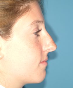 before rhinoplasty female patient right side view case 2303
