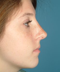 after rhinoplasty female patient right side view case 2303