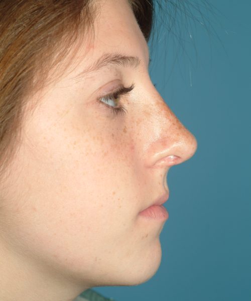 after rhinoplasty female patient right side view case 2303