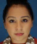 before rhinoplasty female patient front view case 2308