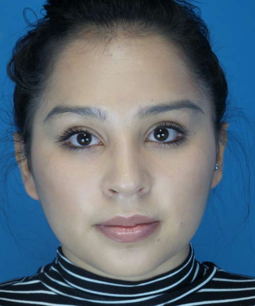 after rhinoplasty female patient front view case 2308