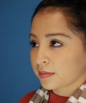 before rhinoplasty female patient left angle view case 2308