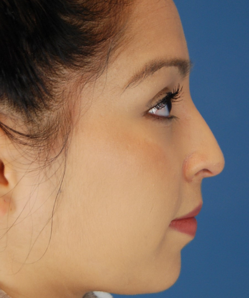 before rhinoplasty female patient right side view case 2308