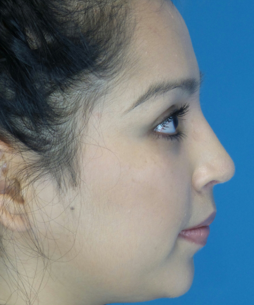 after rhinoplasty female patient right side view case 2308