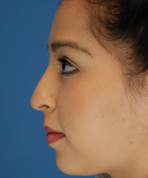 before rhinoplasty female patient left side view case 2308