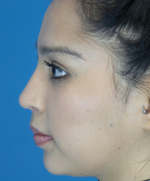 after rhinoplasty female patient left side view case 2308