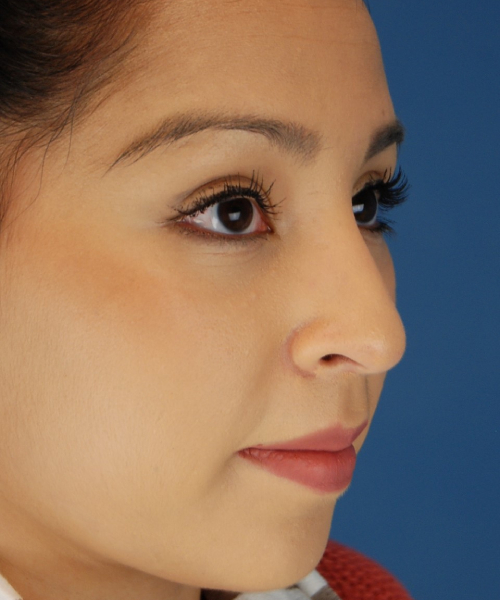 before rhinoplasty female patient right angle view case 2308