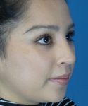 after rhinoplasty female patient right angle view case 2308